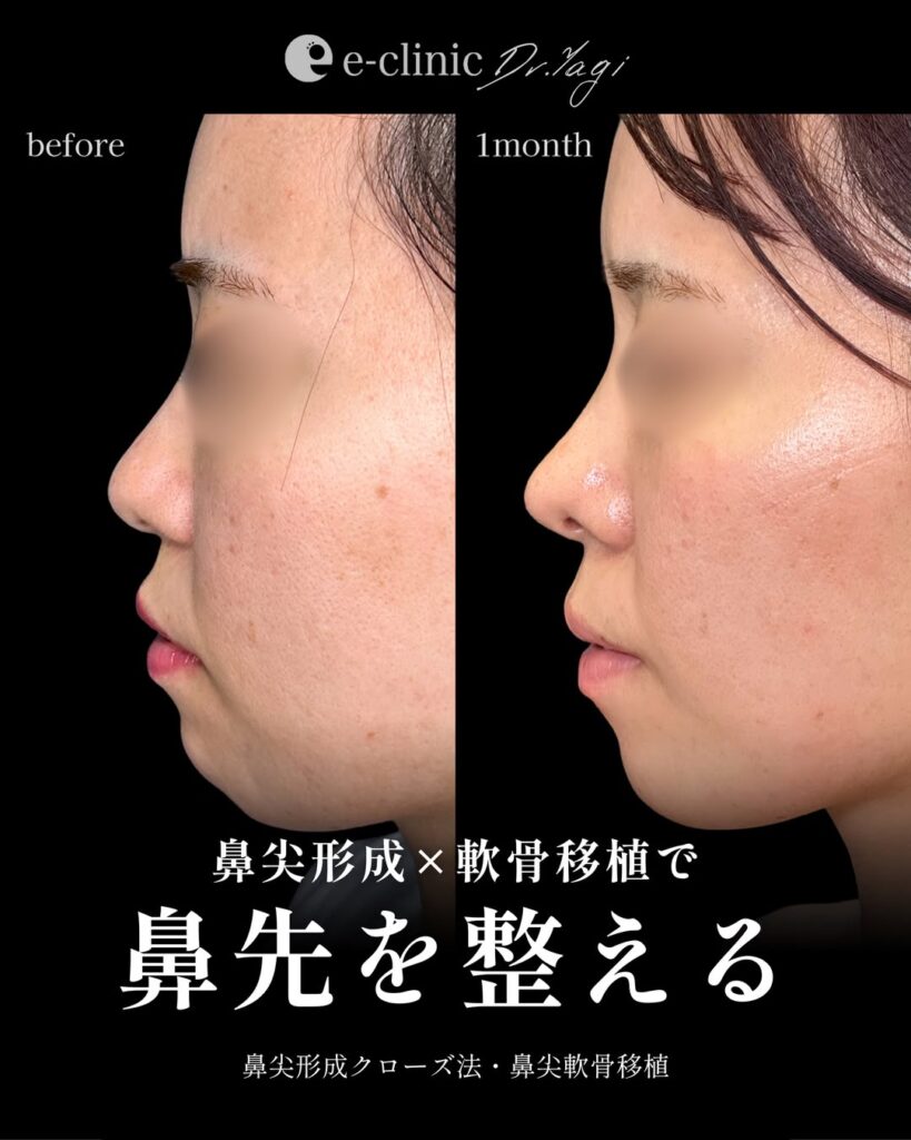 鼻尖形成と鼻尖軟骨移植の症例写真