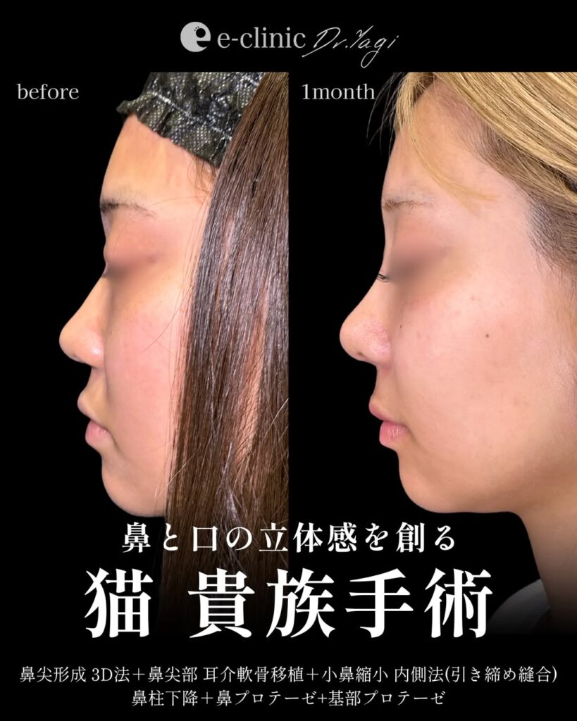 鼻尖形成と耳介軟骨移植と小鼻縮小と鼻柱下降とプロテーゼの症例写真