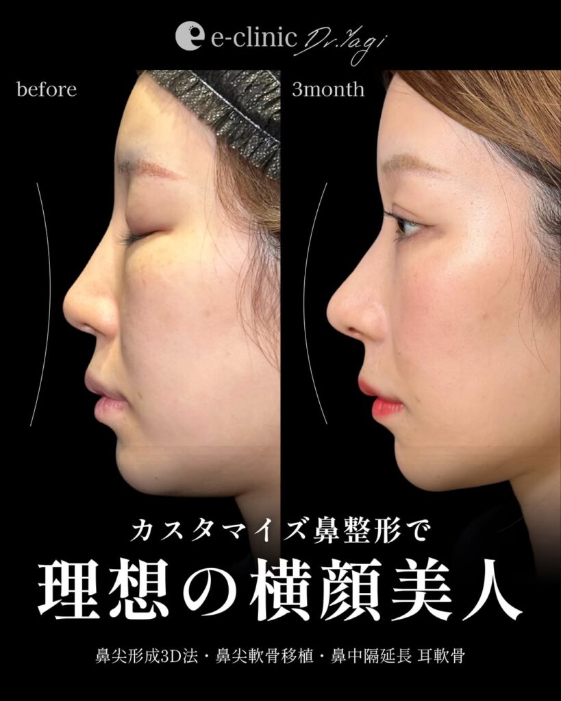 鼻尖形成と鼻尖軟骨移植と鼻中隔延長症例写真