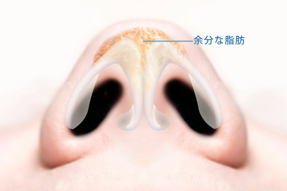 余分な脂肪の除去