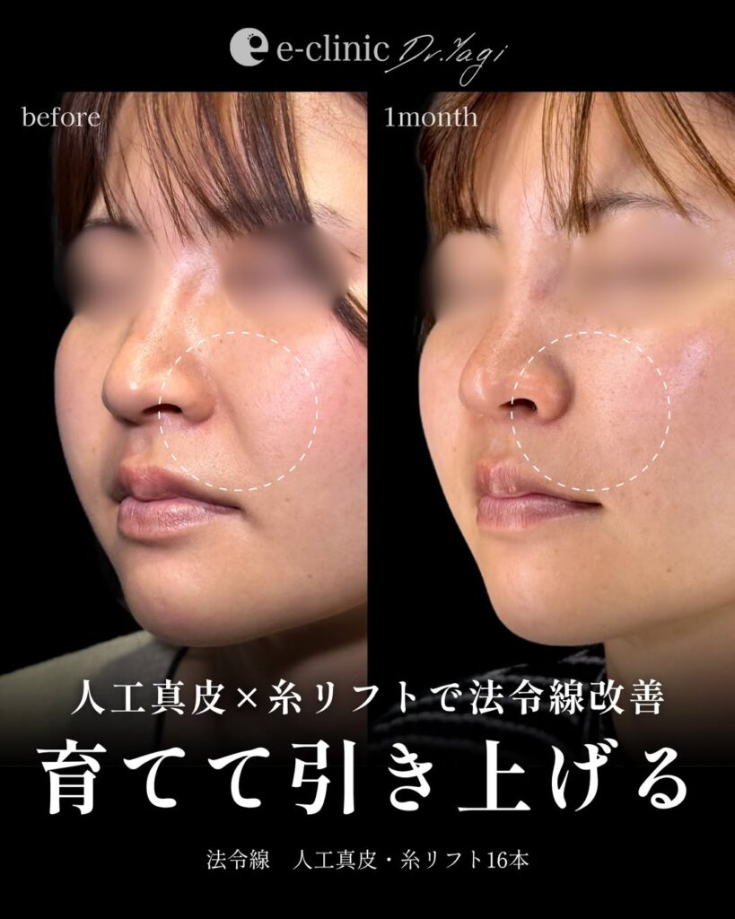 人工真皮と糸リフトの症例写真
