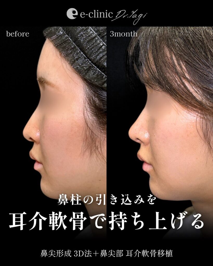 鼻尖形成と耳介軟骨移植の症例写真 (2)