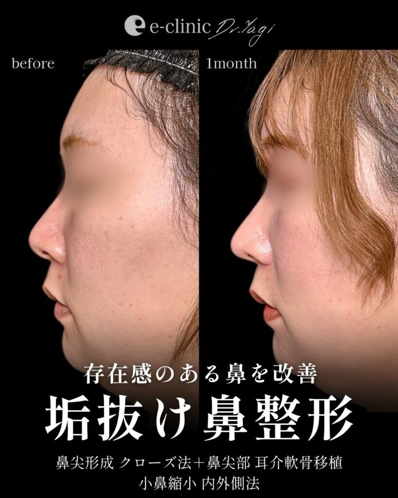 鼻尖形成と耳介軟骨移植と小鼻縮小の症例写真