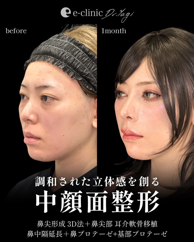 鼻尖形成と耳介軟骨移植と鼻中隔延長とプロテーゼと貴族手術の症例写真