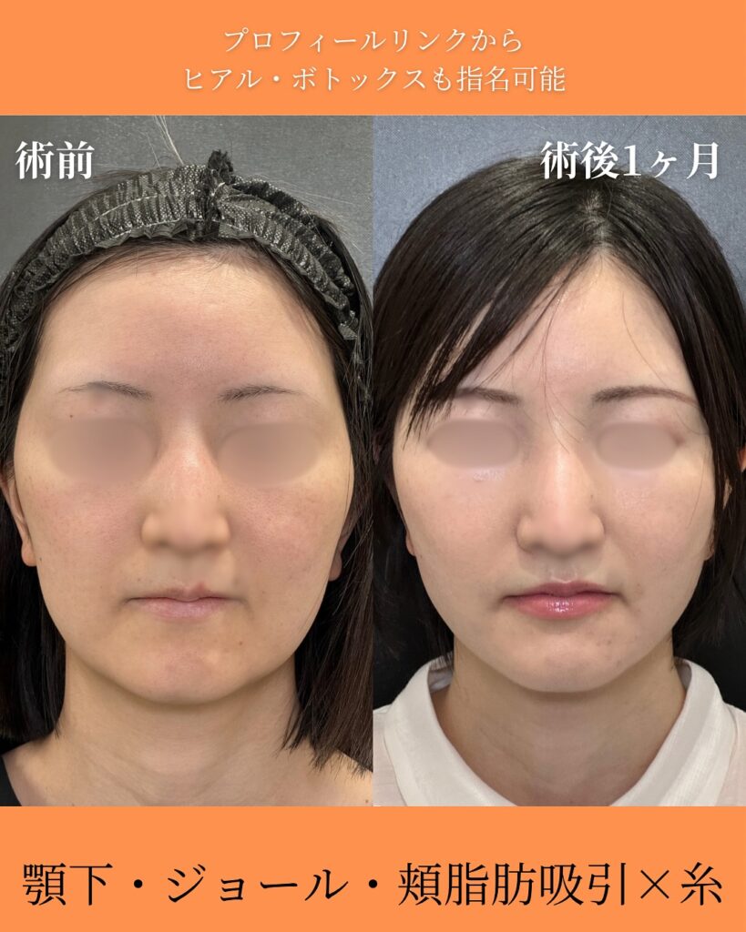 ジョールファットと糸リフトの症例写真