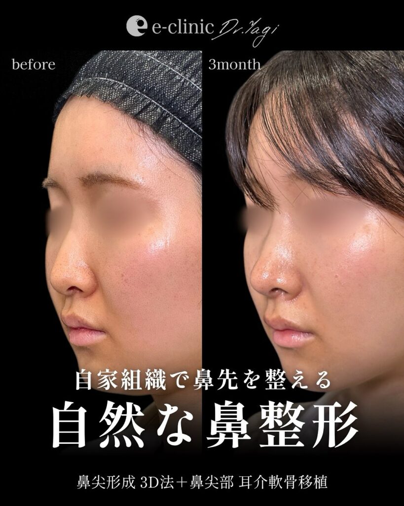 鼻尖形成と耳介軟骨移植の症例写真 (3)
