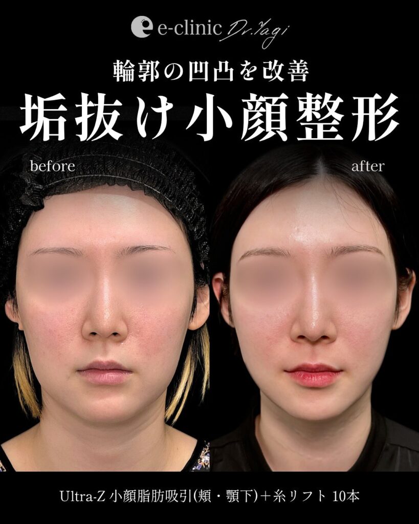 小顔脂肪吸引と糸リフトの症例写真 (4)