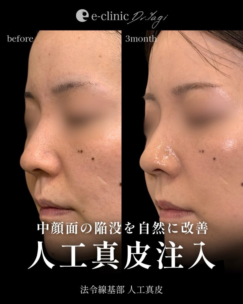 人工真皮の症例写真