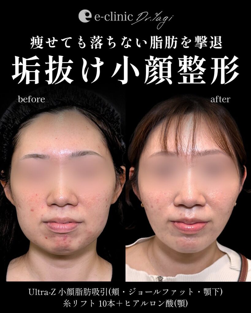 小顔脂肪吸引と糸リフトと顎のヒアルロン酸の症例写真 (3)