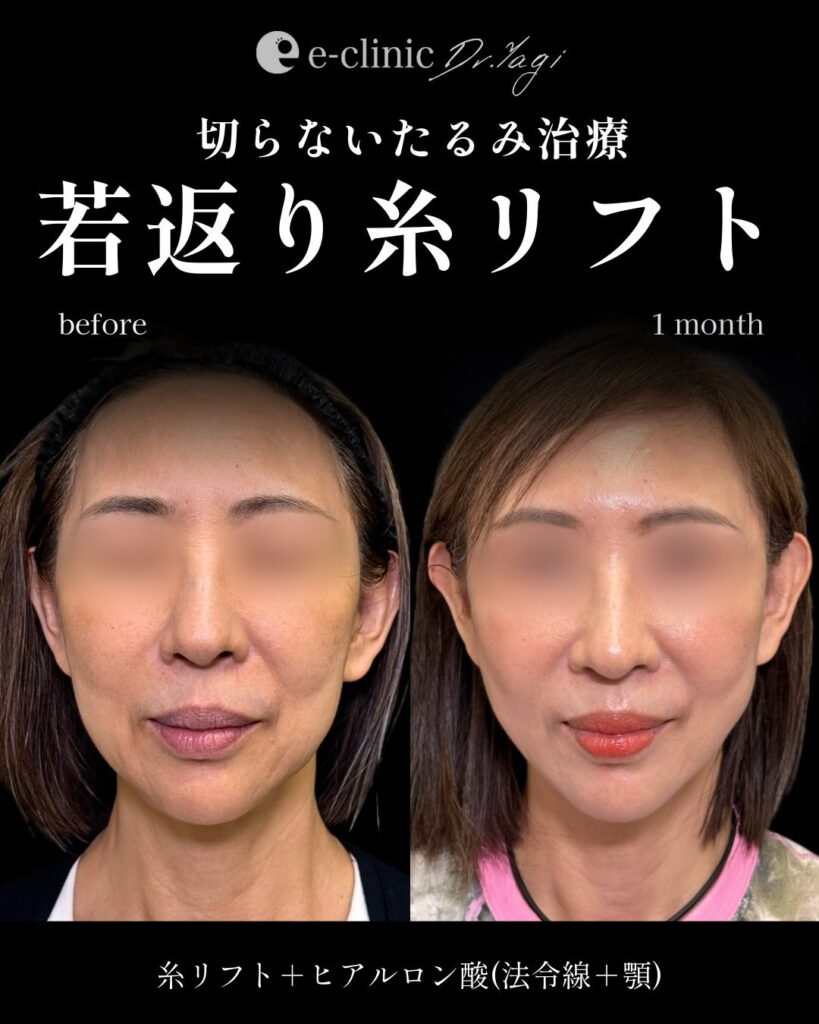 糸リフトとヒアルロン酸の症例写真