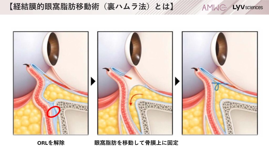 10_経結膜的眼窩脂肪移動術（裏ハムラ法）とは