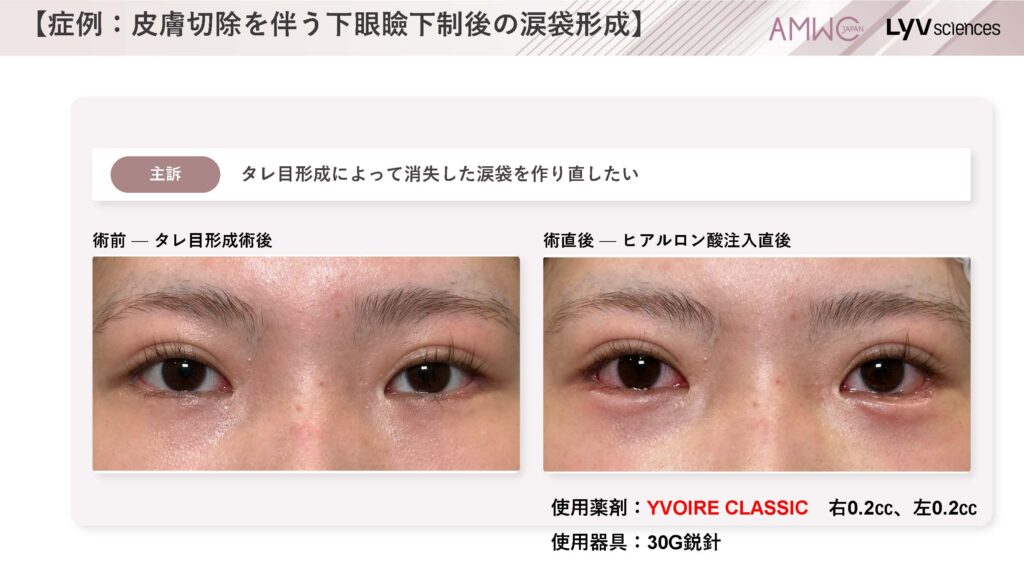 22_症例：皮膚切除を伴う下眼瞼下制後の涙袋形成